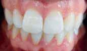 Эстетическая реставрация передних зубов