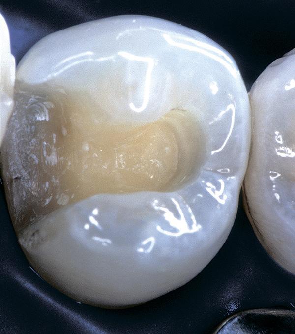 Как выбрать правильный адгезив для реставраций дистальных зубов?