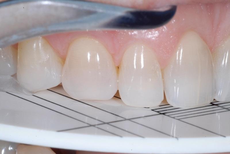 Системный подход к моделированию фронтальных зубов