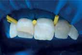 Эстетическая реставрация передних зубов