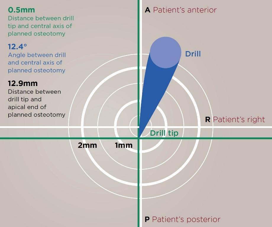 Динамическая навигация при установке дентальных имплантатов: основные концепции и правила