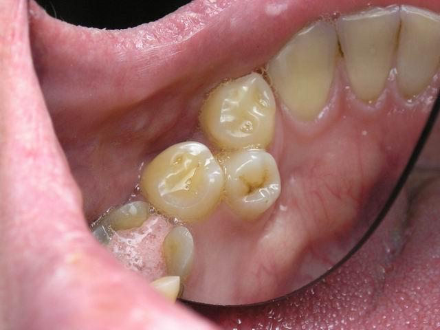 Дистопия зубов - одно из показаний к удалению зуба