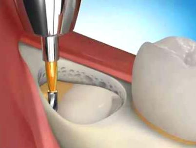 Варианты экстракции ретинированных зубов