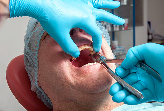 Варианты оперативного вмешательства удаления зуба с дистопией