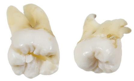 Показания к удалению зубов с дистопией