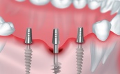 протезирование зубов на базальных имплантах