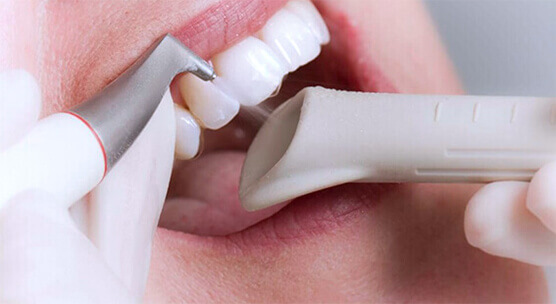 Процесс проведения процедуры чистки зубов air-flow