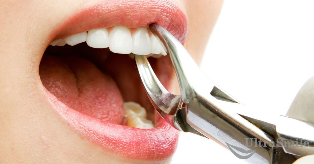 10 последствий после удаления зуба, которые считаются нормой