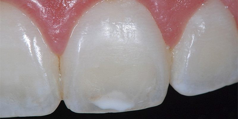 Начальный кариес в стадии пятна – идти к стоматологу или лечить самостоятельно?