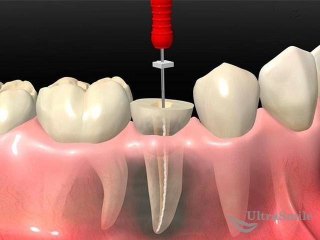 Пульпит зуба у взрослых: симптомы и формы заболевания