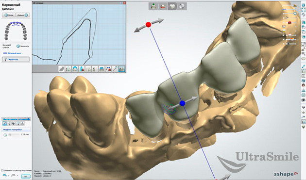 Технология CAD/CAM: когда протез может быть идеальным
