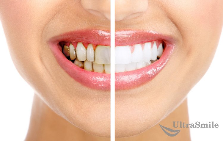 6 методов удаления зубного налета