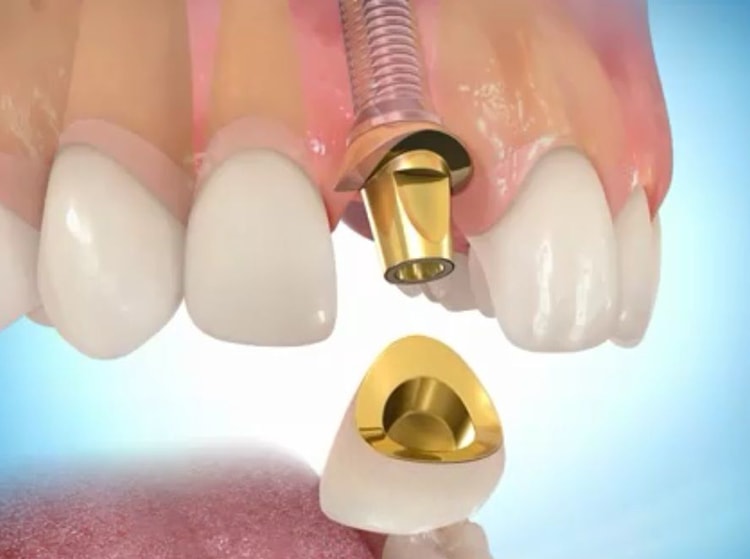 6 этапов проведения классической имплантации зубов