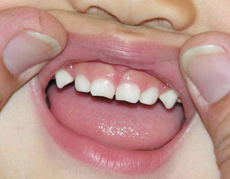 5 интересных фактов о «глазных зубах»