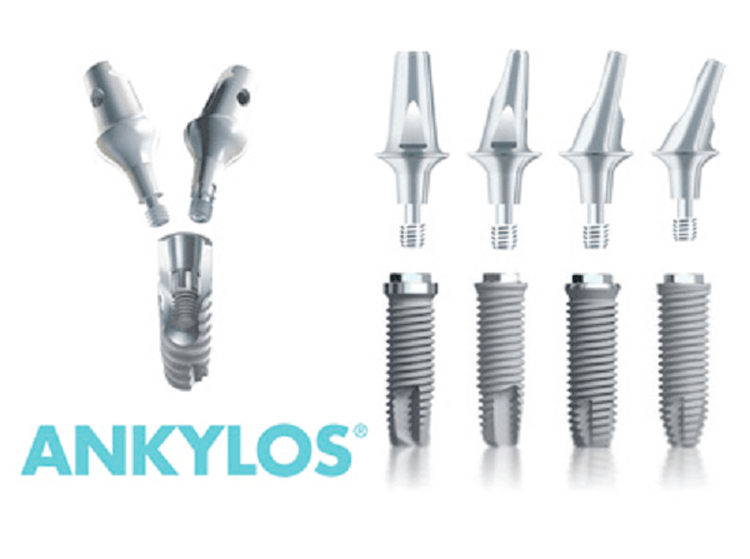 Обзор имплантов Ankylos («Анкилоз»): премиум-качество от немецкого производителя