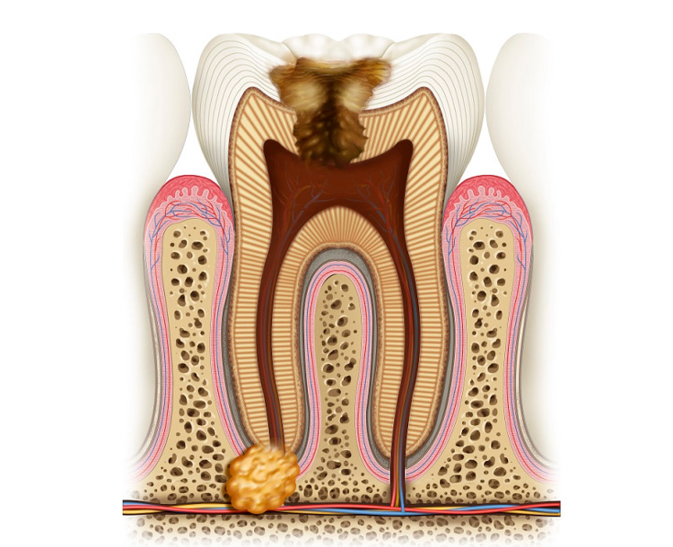 3 основных метода лечения гранулемы с гноем на корне зуба