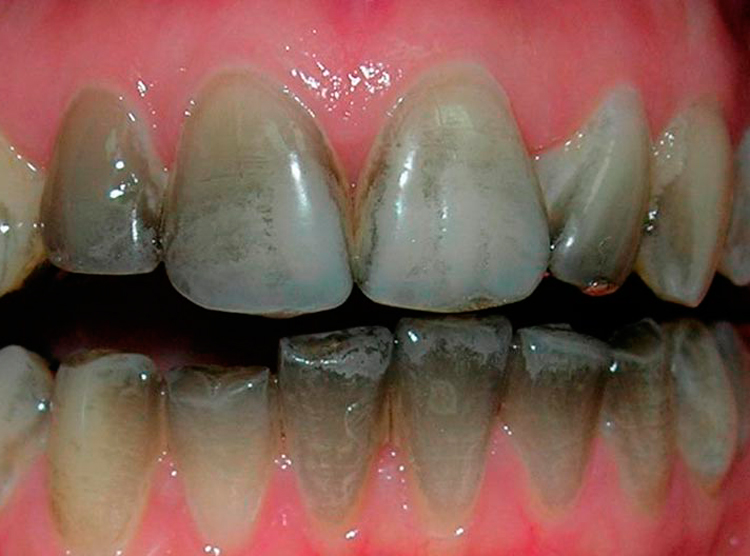 8 распространенных причин появления черного налета на зубах