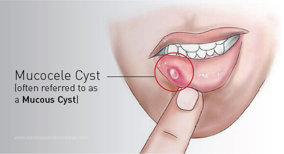 Dental Cysts- Mucocele Cyst