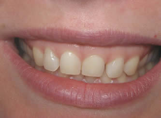 Gum reshaping and veneers were used to improve her smile.