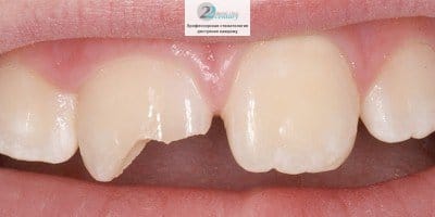 Повреждение зуба при травме