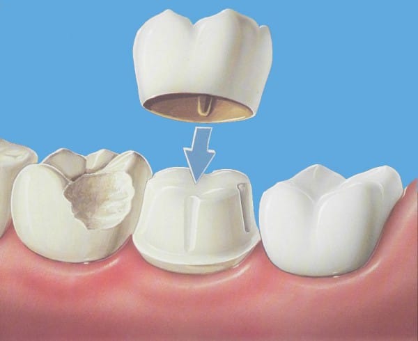 При помощи металлокерамической коронки можно заменить любой зуб