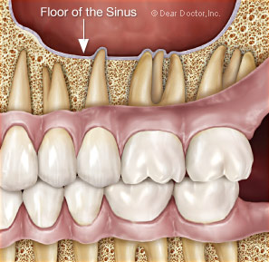 Floor of the sinus