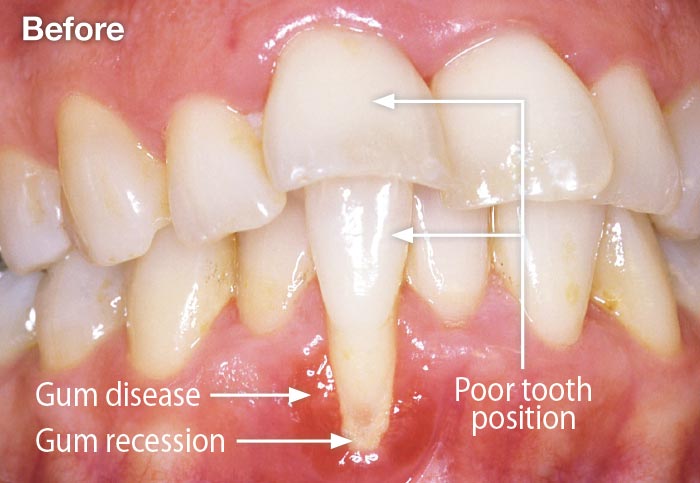 Gum disease and gum recession.