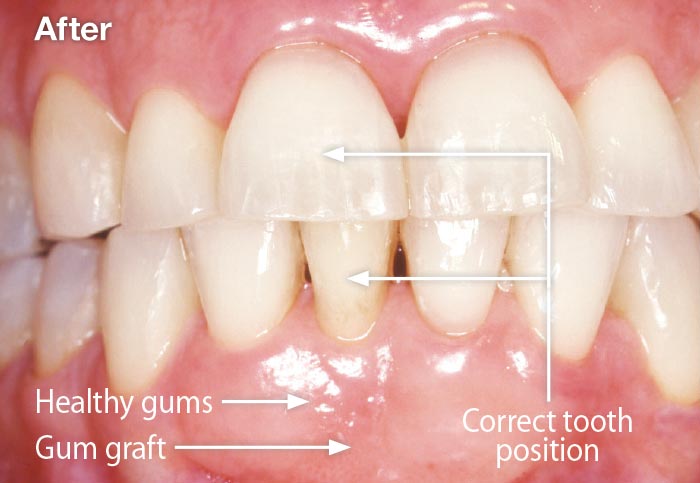 Periodontal plastic surgery.