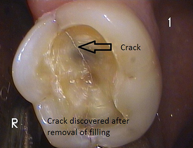 fix-cracked-tooth.jpg