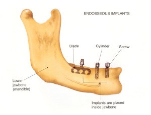 endosseous implants