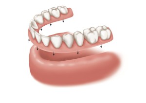 Removable Complete Denture
