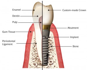 Parts-of-a-tooth-implant