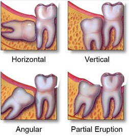 types-of-wisdom-tooth-impactions