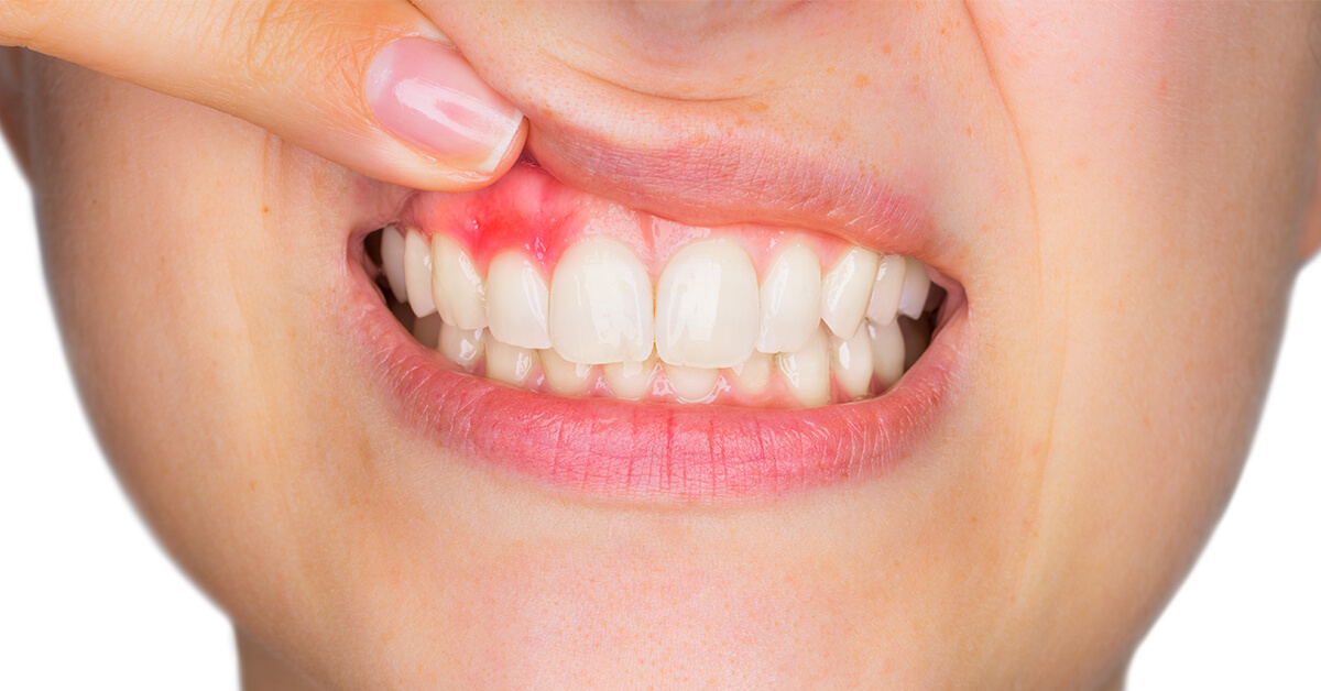 Do you suffer from bleeding gums? It may lead to gum disease. Did you know oral probiotics may heal gum disease?