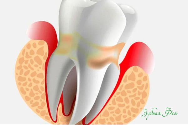 периодонтит зуба