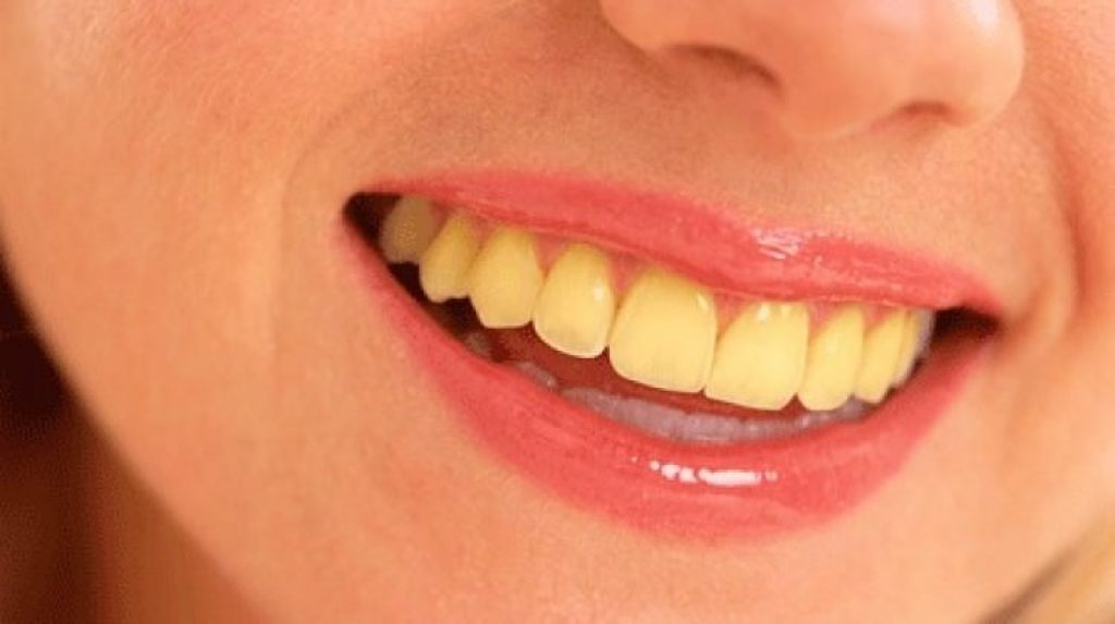 Yellow Teeth System