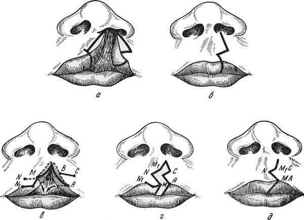 Схема этапов пластики губы при односторонних расщелинах