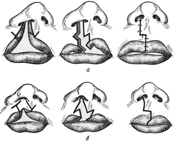Схемы этапов пластики верхней губы при односторонних расщелинах