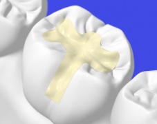 Виды стоматологических пломбировочных материалов
