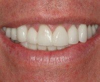 Close-up of crooked teeth fixed with porcelain veneers