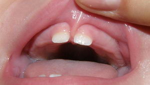 Подрезание короткой уздечки верхней губы