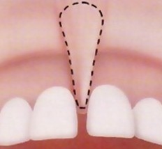 Подрезание короткой уздечки верхней губы