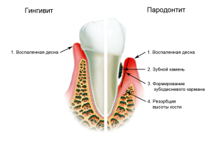 Зубная боль при гингивите и пародонтите