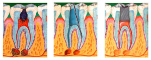 Зубная боль при пульпите