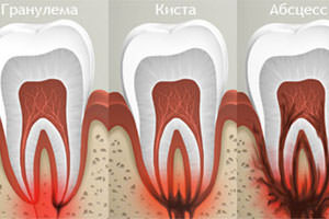 Зубная боль при кисте или гранулеме