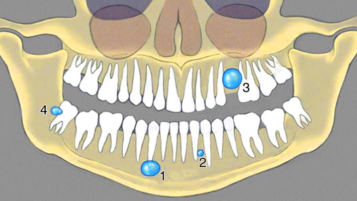 Расположение кисты зуба