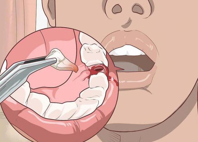 Альвеолит лунки после удаления зуба - причины, симптомы, лечение