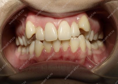Неровные зубы фото