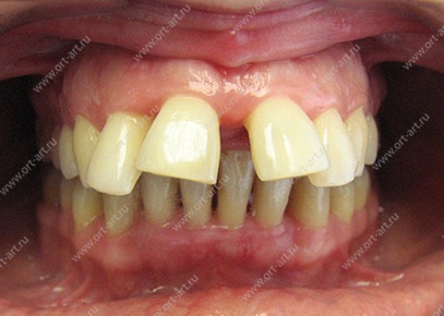 Протрузия зубов фото