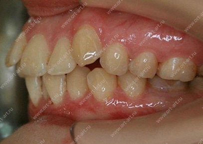 Протрузия зубов лечение